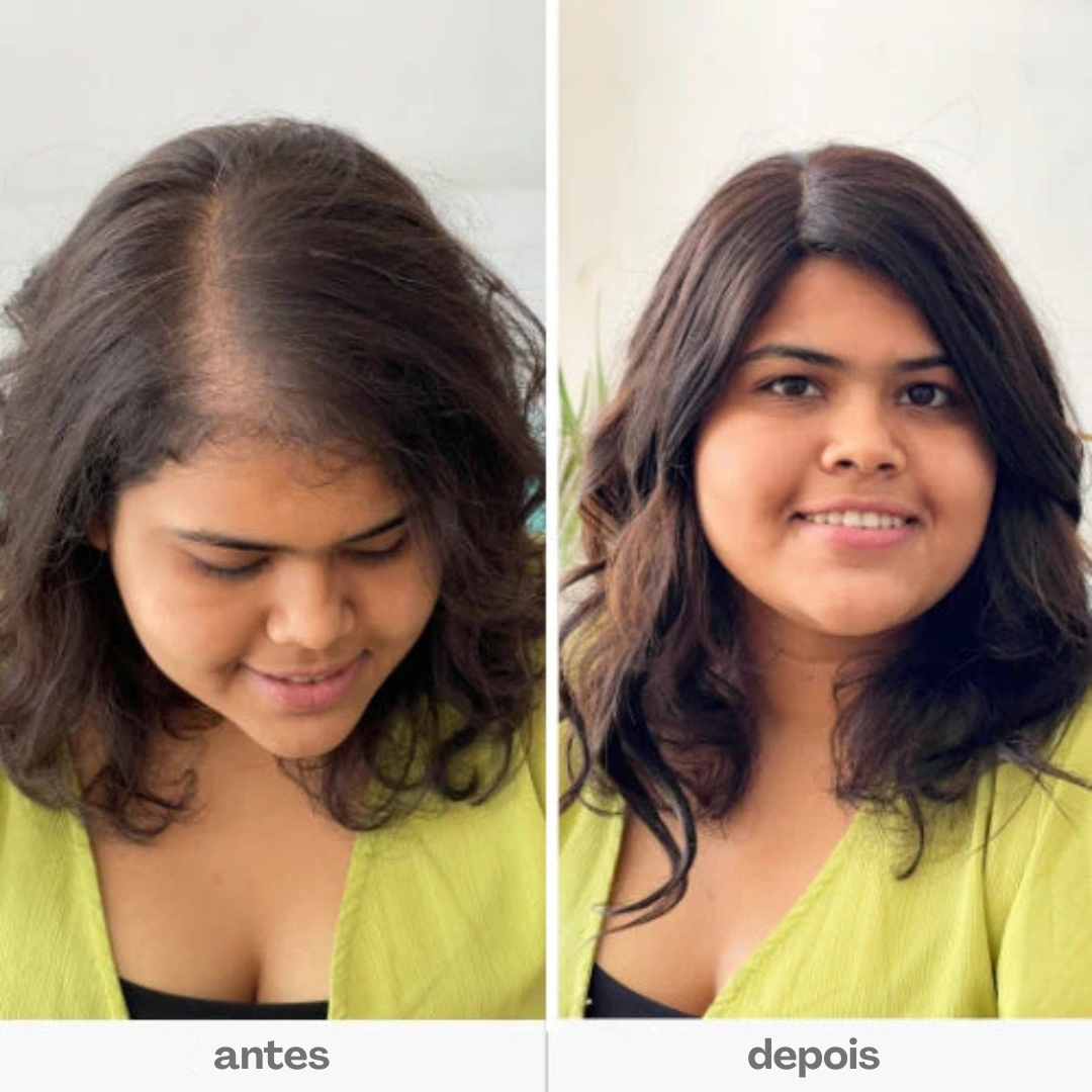 Aplique Mini Topo - (Para Alopecia, Falhas, Cabelos Ralos e com Queda) - Cabelo Humano