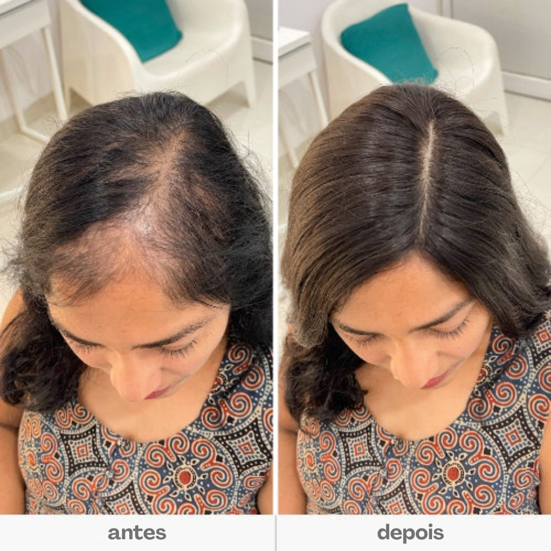 Aplique Mini Topo - (Para Alopecia, Falhas, Cabelos Ralos e com Queda) - Cabelo Humano