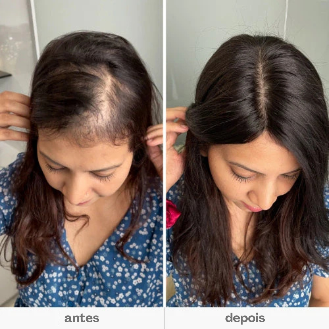 Aplique Mini Topo - (Para Alopecia, Falhas, Cabelos Ralos e com Queda) - Cabelo Humano