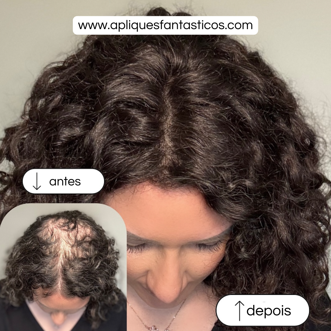 Aplique Topo de Cabeça Cacheado - Fibra Orgânica (Para Alopecia, Falhas, Cabelos Ralos e com Queda) Resultado