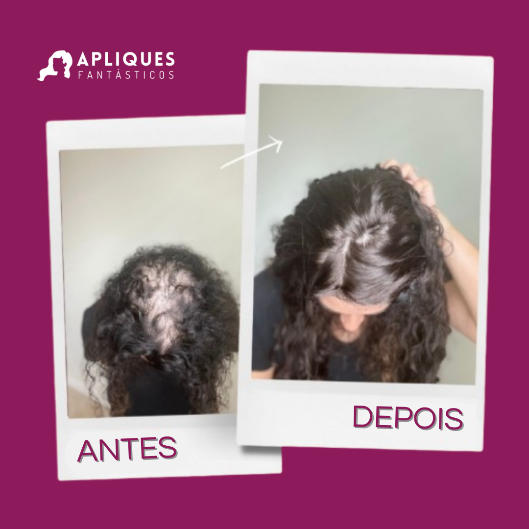 Aplique Topo de Cabeça Cacheado - Fibra Orgânica (Para Alopecia, Falhas, Cabelos Ralos e com Queda) Resultado 2